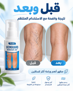 جل علاج الدوالي الفوري – تخلّص من الألم والعروق البارزة بـ 10 أيام